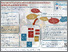 [thumbnail of Poster presentation: Co-creating a complex intervention to increase leisure participation following stroke]